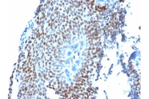 Formalin-fixed, paraffin-embedded human Bladder Carcinoma stained with p21 Mouse Monoclonal Antibody (CIP1/823).