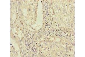 Immunohistochemistry of paraffin-embedded human lung cancer using ABIN7163315 at dilution of 1:100 (PLAA antibody  (AA 536-795))