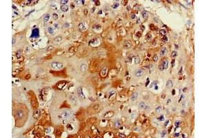 Immunohistochemistry of paraffin-embedded human cervical cancer using ABIN7171915 at dilution of 1:100
