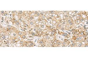 Immunohistochemistry of paraffin-embedded Human liver cancer tissue using SH3GL2 Polyclonal Antibody at dilution of 1:80(x200) (SH3G2 antibody)