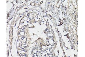 Immunohistochemistry of paraffin-embedded Human breast using BAP1 Polyclonal Antibody at dilution of 1:150 (40x lens). (BAP1 antibody)