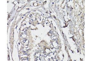 Immunohistochemistry of paraffin-embedded Human breast using BAP1 Polyclonal Antibody at dilution of 1:150 (40x lens).
