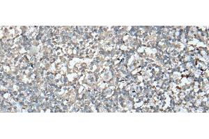 Immunohistochemistry of paraffin-embedded Human tonsil tissue using VASP Polyclonal Antibody at dilution of 1:30(x200) (VASP antibody)