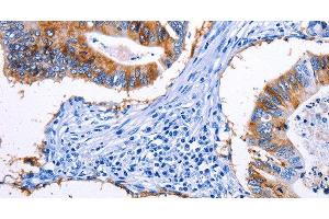 Immunohistochemistry of paraffin-embedded Human colon cancer tissue using EPCAM Polyclonal Antibody at dilution 1:45 (EpCAM antibody)