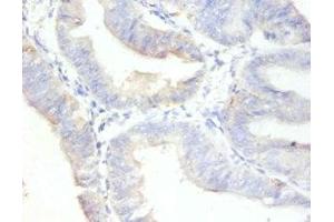 Immunohistochemistry of paraffin-embedded human endometrial cancer using ABIN7164742 at dilution of 1:100 (Ki-67 antibody  (AA 3120-3256))