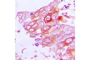 Immunohistochemical analysis of MUC13 staining in human lung cancer formalin fixed paraffin embedded tissue section. (MUC13 antibody  (C-Term))