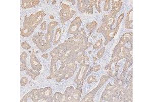 IHC analysis of Cytokeratin 19 using anti-Cytokeratin 19 antibody (ABIN3043288). (Cytokeratin 19 antibody  (C-Term))