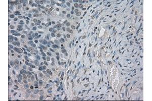 Immunohistochemical staining of paraffin-embedded Adenocarcinoma of ovary tissue using anti-SLC2A5mouse monoclonal antibody. (SLC2A5 antibody)