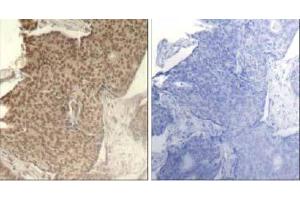 Immunohistochemical analysis of paraffin-embedded human breast carcinoma tissue using HDAC2 (Phospho- Ser394) antibody (E011191). (HDAC2 antibody  (pSer394))