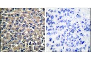 Immunohistochemistry analysis of paraffin-embedded human breast carcinoma tissue, using MMP-19 Antibody. (MMP19 antibody  (AA 11-60))
