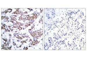 Immunohistochemical analysis of paraffin-embedded human breast carcinoma tissue using MEF2A(Phospho-Thr312) Antibody(left) or the same antibody preincubated with blocking peptide(right). (MEF2A antibody  (pThr312))