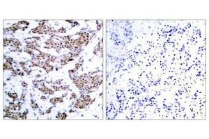 Immunohistochemical analysis of paraffin-embedded human breast carcinoma tissue using MEF2A(Phospho-Thr312) Antibody(left) or the same antibody preincubated with blocking peptide(right).