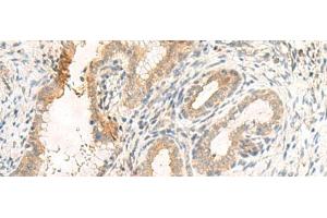 Immunohistochemistry of paraffin-embedded Human cervical cancer tissue using GPR89A/GPR89B Polyclonal Antibody at dilution of 1:25(x200)