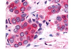Anti-Nor-1 / NR4A3 antibody IHC of human Breast, Carcinoma. (NR4A3 antibody  (Modulating Domain))