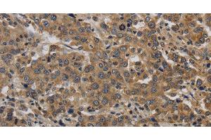 Immunohistochemistry of paraffin-embedded Human liver cancer tissue using KIF4A Polyclonal Antibody at dilution 1:40 (KIF4A antibody)