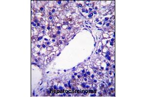 PNPLA4 Antibody (C-term) (ABIN657892 and ABIN2846844) immunohistochemistry analysis in formalin fixed and paraffin embedded human hepatocarcinoma followed by peroxidase conjugation of the secondary antibody and DAB staining. (PNPLA4 antibody  (C-Term))