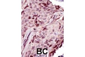 Formalin-fixed and paraffin-embedded human cancer tissue reacted with the primary antibody, which was peroxidase-conjugated to the secondary antibody, followed by DAB staining. (IRAK4 antibody  (N-Term))