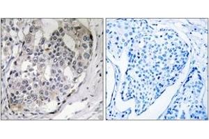 Immunohistochemistry analysis of paraffin-embedded human breast carcinoma, using DARPP-32 (Phospho-Thr75) Antibody. (DARPP32 antibody  (pThr75))