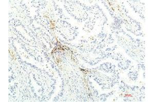 Immunohistochemical analysis of paraffin-embedded Human Lung Carcinoma Tissue using JAK1 Mouse mAb diluted at 1:200.