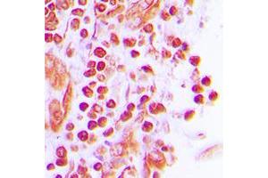 Immunohistochemical analysis of JUNB staining in human breast cancer formalin fixed paraffin embedded tissue section. (JunB antibody  (C-Term))