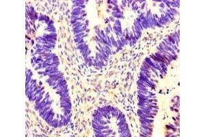 Immunohistochemistry of paraffin-embedded human ovarian cancer using ABIN7142095 at dilution of 1:100 (14-3-3 gamma antibody  (AA 113-194))
