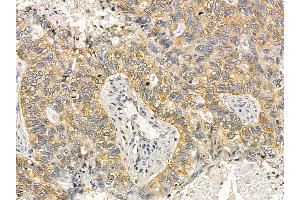 Cytokeratin 17 Mouse Monoclonal Antibody at 1/100 staining human lung cancer and adjacent non-tumor tissue by IHC-P.