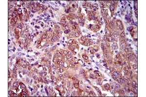 Immunohistochemical analysis of paraffin-embedded endometrial cancer tissues using CLGN mouse mAb with DAB staining. (Calmegin antibody  (AA 249-405))