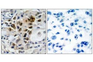 Immunohistochemical analysis of paraffin-embedded human lung carcinoma tissue, using AFX (Ab-197) antibody (E0 21162 ). (FOXO4 antibody)