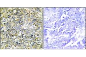 Immunohistochemistry analysis of paraffin-embedded human lung carcinoma tissue, using UBXD5 Antibody. (UBXN11 antibody  (AA 131-180))