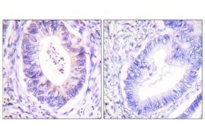 Immunohistochemistry analysis of paraffin-embedded human colon carcinoma tissue using p90 RSK (epitope around residue 573) antibody. (RPS6KA3 antibody  (Thr573))