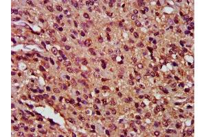 IHC image of ABIN7146901 diluted at 1:400 and staining in paraffin-embedded human glioma performed on a Leica BondTM system. (FLIP antibody  (AA 1-250))