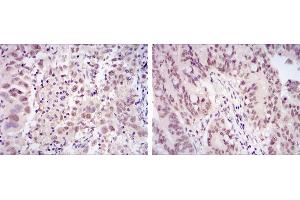 Immunohistochemical analysis of paraffin-embedded endometrial cancer tissues (left) and rectum cancer tissues (right) using CDK9 mouse mAb with DAB staining. (CDK9 antibody)