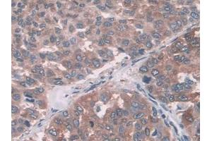 DAB staining on IHC-P; Samples: Human Liver cancer Tissue (FUT6 antibody  (AA 35-359))