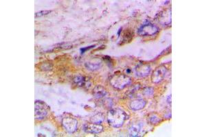 Immunohistochemical analysis of CaMK1 alpha (pT177) staining in human lung cancer formalin fixed paraffin embedded tissue section. (CAMK1 antibody  (pSer177))