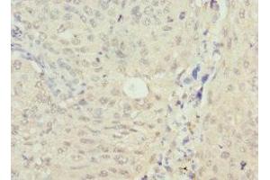 Immunohistochemistry of paraffin-embedded human lung cancer using ABIN7161740 at dilution of 1:100 (NSFL1C antibody  (AA 1-185))