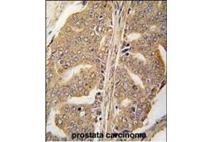Formalin-fixed and paraffin-embedded human prostata carcinoma tissue reacted with PXN Antibody  (ABIN390376 and ABIN2840778) , which was peroxidase-conjugated to the secondary antibody, followed by DAB staining. (Paxillin antibody  (AA 94-125))