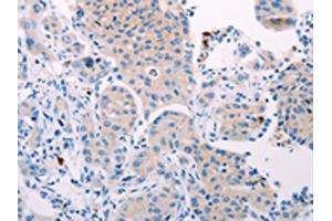 The image on the left is immunohistochemistry of paraffin-embedded Human lung cancer tissue using ABIN7131321(TEKT4 Antibody) at dilution 1/10, on the right is treated with fusion protein.