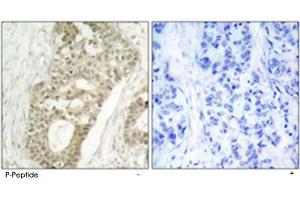 Immunohistochemical analysis of paraffin-embedded human breast carcinoma tissue using PRKCD (phospho S645) polyclonal antibody . (PKC delta antibody  (pSer645))