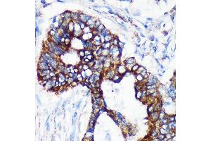 Immunohistochemistry of paraffin-embedded Human colon carcinoma using [KO Validated] CHCHD2 Rabbit pAb (ABIN7266448) at dilution of 1:100 (40x lens). (CHCHD2 antibody  (AA 75-145))