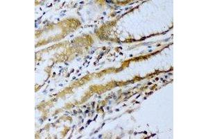 Immunohistochemical analysis of ERG staining in human stomach cancer formalin fixed paraffin embedded tissue section. (ERG antibody)