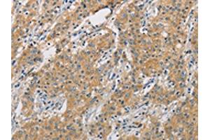 The image on the left is immunohistochemistry of paraffin-embedded Human gastric cancer tissue using ABIN7128504(ARHGEF7 Antibody) at dilution 1/40, on the right is treated with fusion protein.