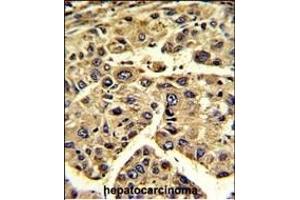 Formalin-fixed and paraffin-embedded human hepatocarcinoma reacted with EIF3H Antibody (C-term), which was peroxidase-conjugated to the secondary antibody, followed by DAB staining. (EIF3H antibody  (C-Term))