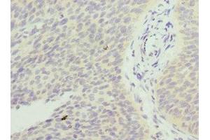 Immunohistochemistry of paraffin-embedded human cervical cancer using ABIN7153251 at dilution of 1:100 (FXYD5 antibody  (AA 22-145))