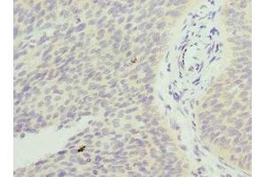 Immunohistochemistry of paraffin-embedded human cervical cancer using ABIN7153251 at dilution of 1:100