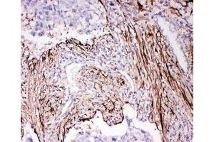 IHC-P: ADAM19 antibody testing of human lung cancer tissue (ADAM19 antibody  (N-Term))