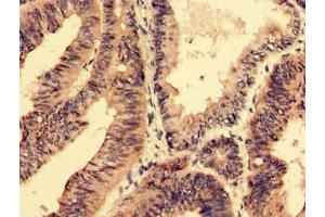Immunohistochemistry analysis of human colon cancer using ABIN7168686 at dilution of 1:100 (SFRP4 antibody  (AA 293-346))