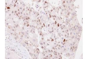 IHC-P Image Immunohistochemical analysis of paraffin-embedded H441 xenograft, using NPAS2, antibody at 1:100 dilution. (NPAS2 antibody  (C-Term))