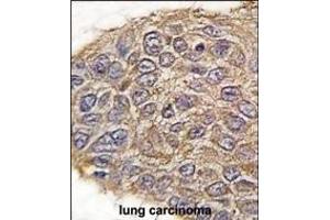 Formalin-fixed and paraffin-embedded human lung carcinoma tissue reacted with ALDOA antibody (N-term) (ABIN389191 and ABIN2839354) , which was peroxidase-conjugated to the secondary antibody, followed by DAB staining. (ALDOA antibody  (N-Term))