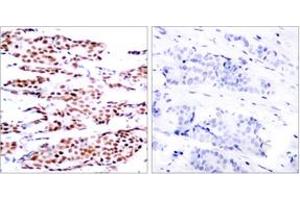 Immunohistochemistry analysis of paraffin-embedded human breast carcinoma, using JunB (Phospho-Ser79) Antibody. (JunB antibody  (pSer79))