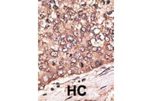 Formalin-fixed and paraffin-embedded human cancer tissue reacted with the primary antibody, which was peroxidase-conjugated to the secondary antibody, followed by DAB staining. (WISP1 antibody  (AA 171-200))